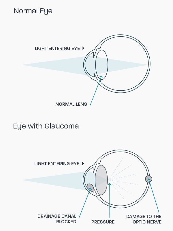 A graphic showing how glaucoma affects the eye