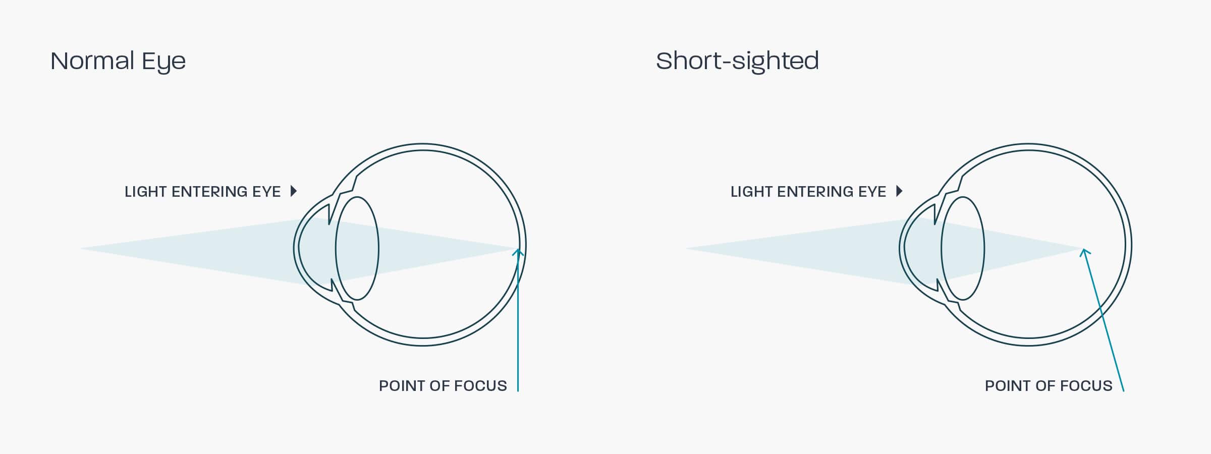 A graphic showing how a myopic eye works