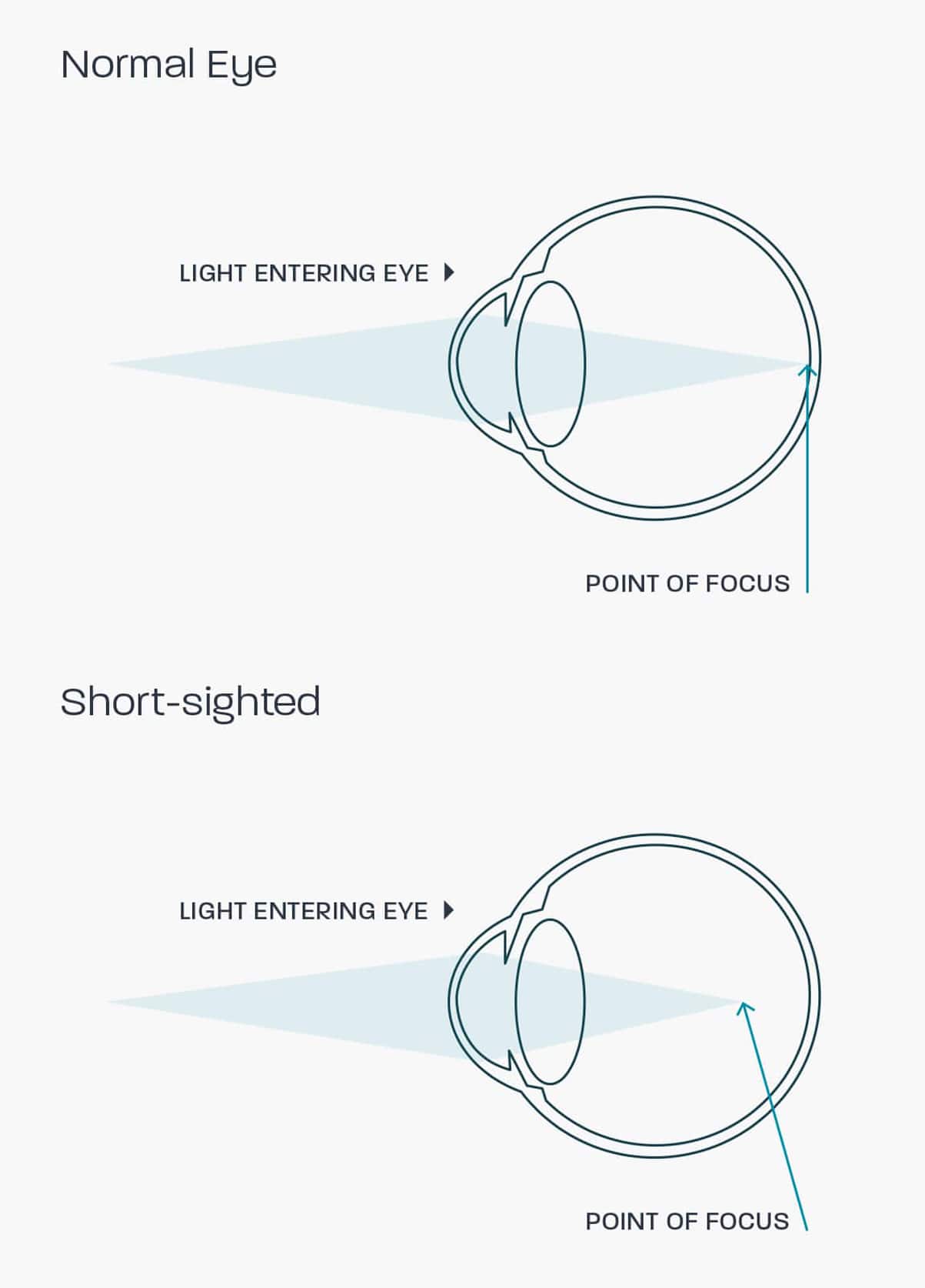 Nearsighted glasses lens type online