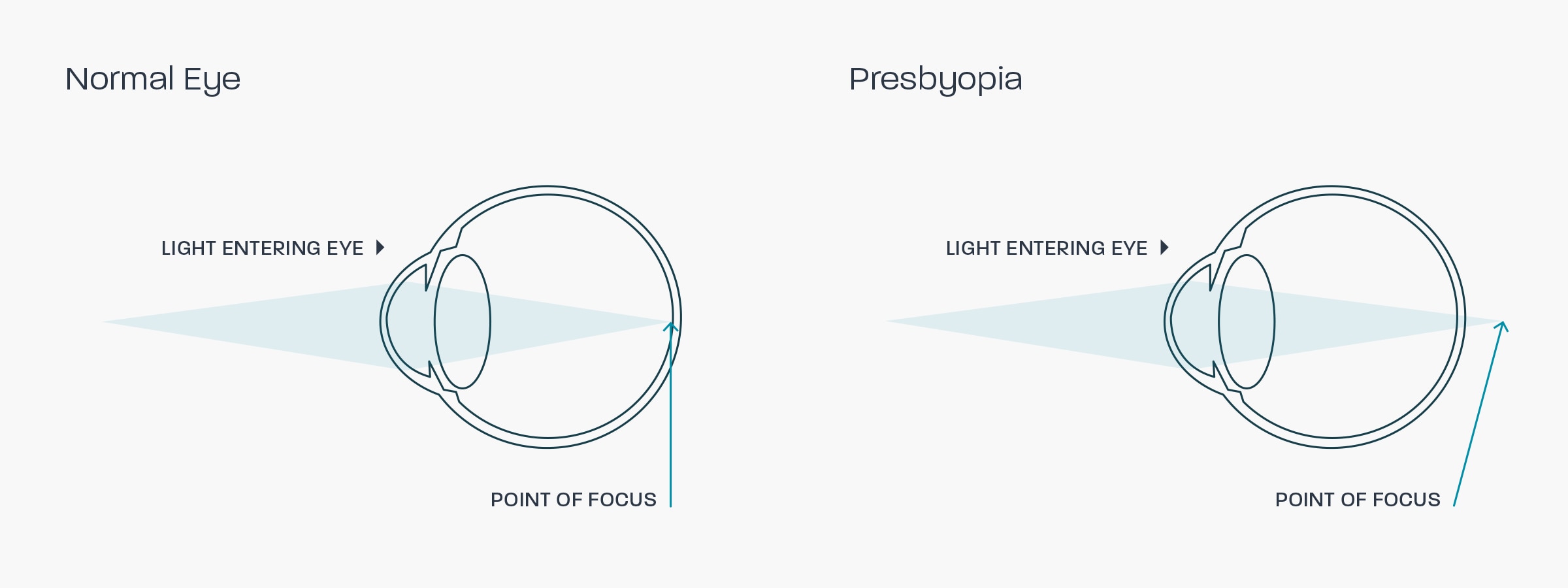 A graphic showing how presbyopia affects the eye